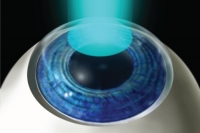 جراحی لیزری چشم PRK و تفاوت آن با LASIK: