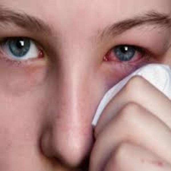 قرمزی چشم و خون گرفتگی چشم: علل و درمان