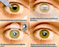 اصلاح پیر چشمی با کاشت ایمپلنت